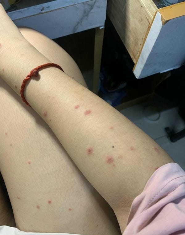 hình ảnh bệnh sởi ở trẻ em 10