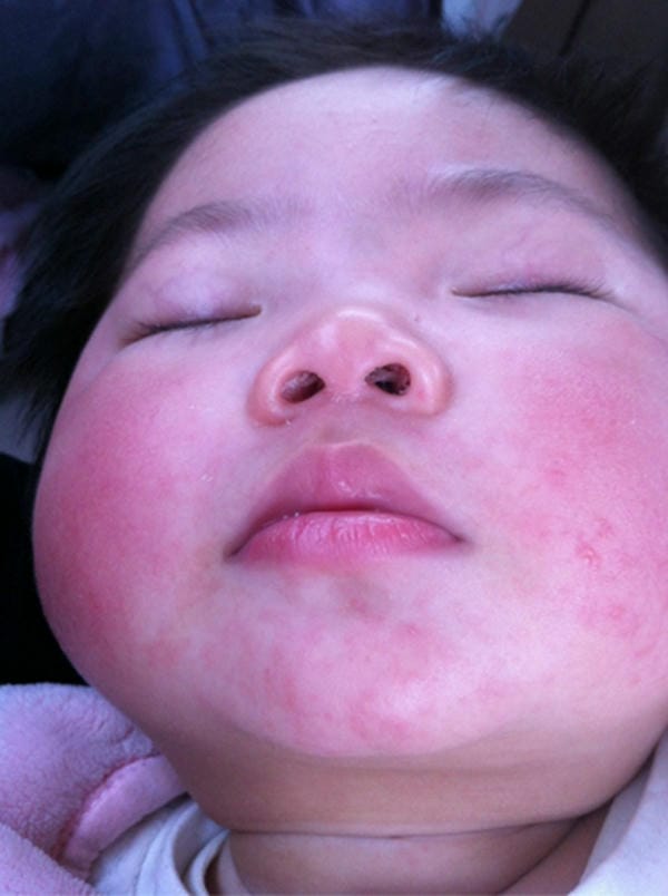 hình ảnh bệnh sởi ở trẻ em 12