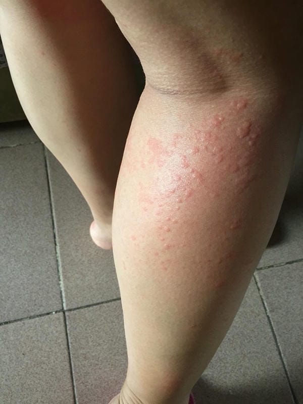 hình ảnh bệnh sởi ở trẻ em 14