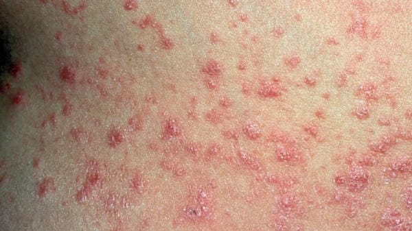 hình ảnh bệnh sởi ở trẻ em 15