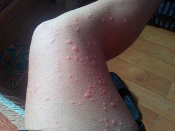 hình ảnh bệnh sởi ở trẻ em 16