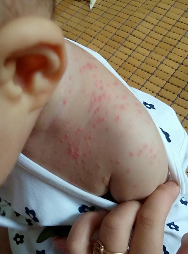 hình ảnh bệnh sởi ở trẻ em 17