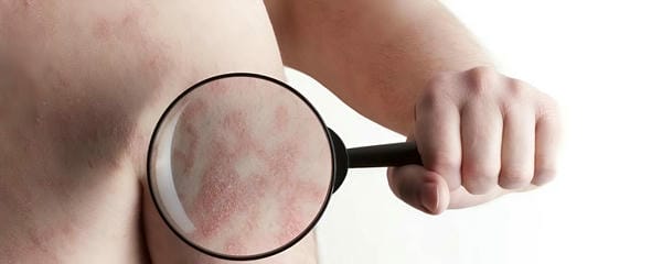 hình ảnh bệnh sởi ở trẻ em 18
