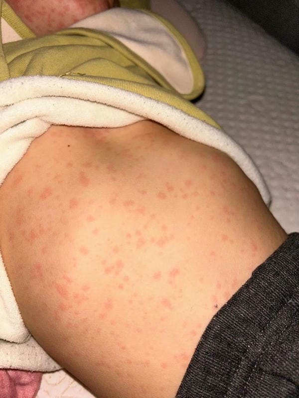 hình ảnh bệnh sởi ở trẻ em 20