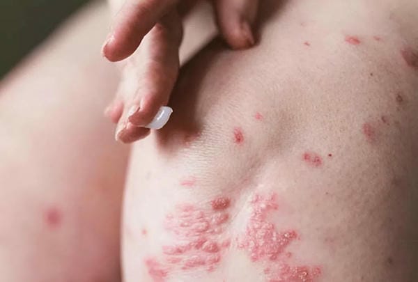 hình ảnh bệnh sởi ở trẻ em 21