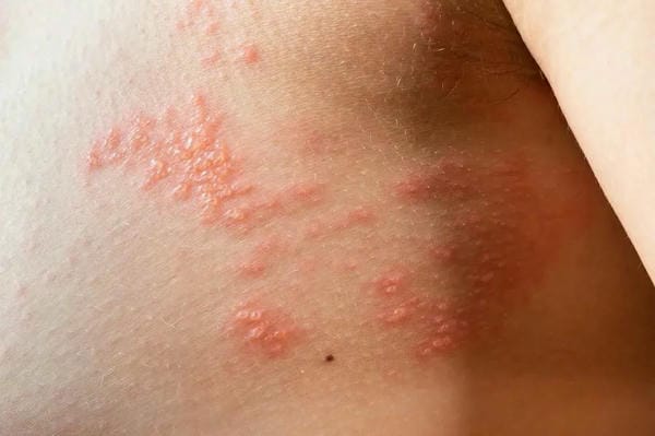 hình ảnh bệnh sởi ở trẻ em 22