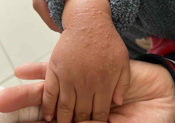 hình ảnh bệnh sởi ở trẻ em 24