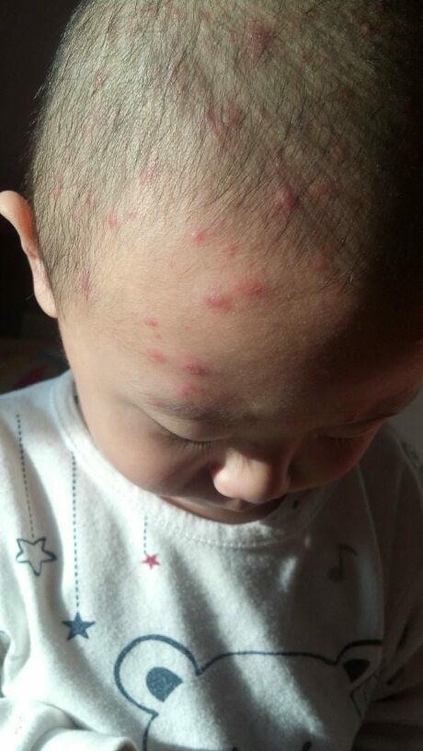 hình ảnh bệnh sởi ở trẻ em 26