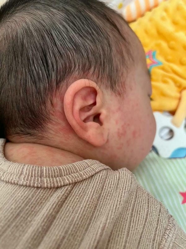 hình ảnh bệnh sởi ở trẻ em 27