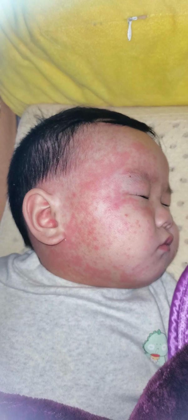 hình ảnh bệnh sởi ở trẻ em 28