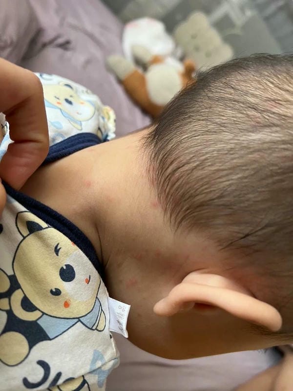 hình ảnh bệnh sởi ở trẻ em 4