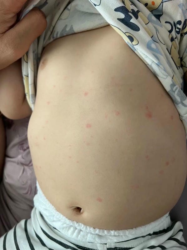 hình ảnh bệnh sởi ở trẻ em 5