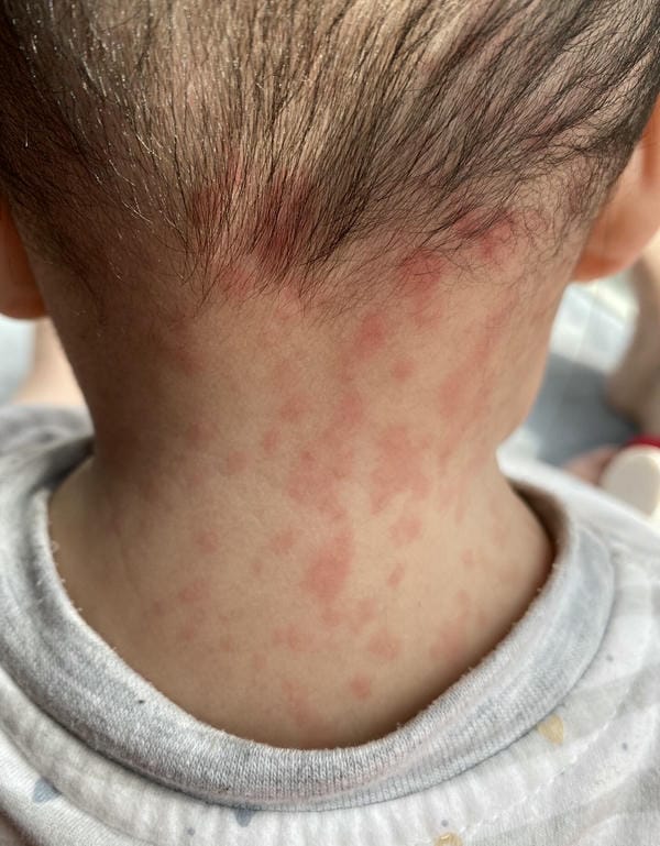 hình ảnh bệnh sởi ở trẻ em 6