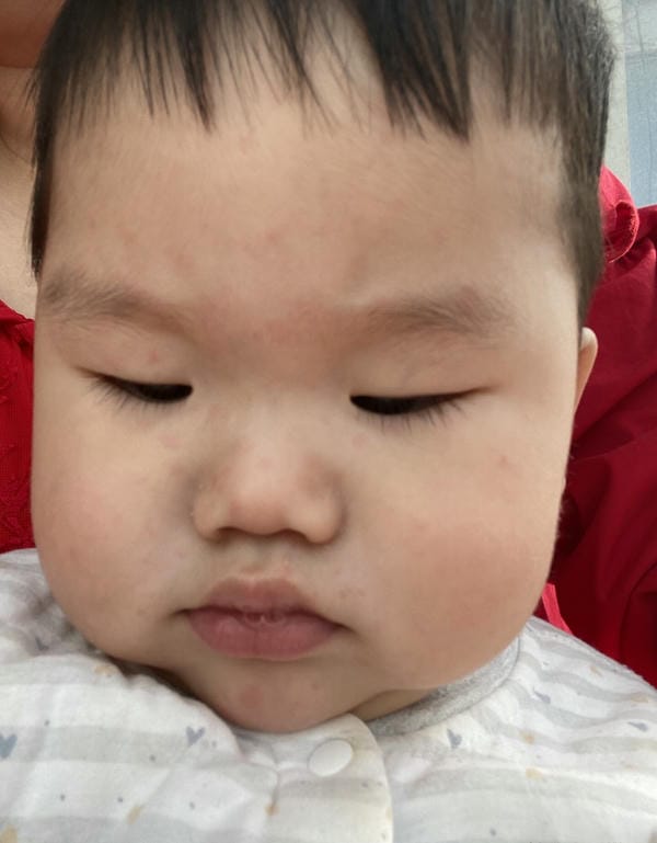hình ảnh bệnh sởi ở trẻ em 8