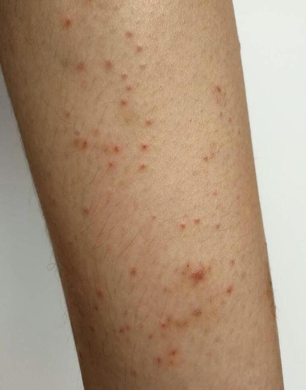 hình ảnh bệnh sởi ở trẻ em 9