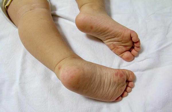 hình ảnh nốt chân tay miệng 13
