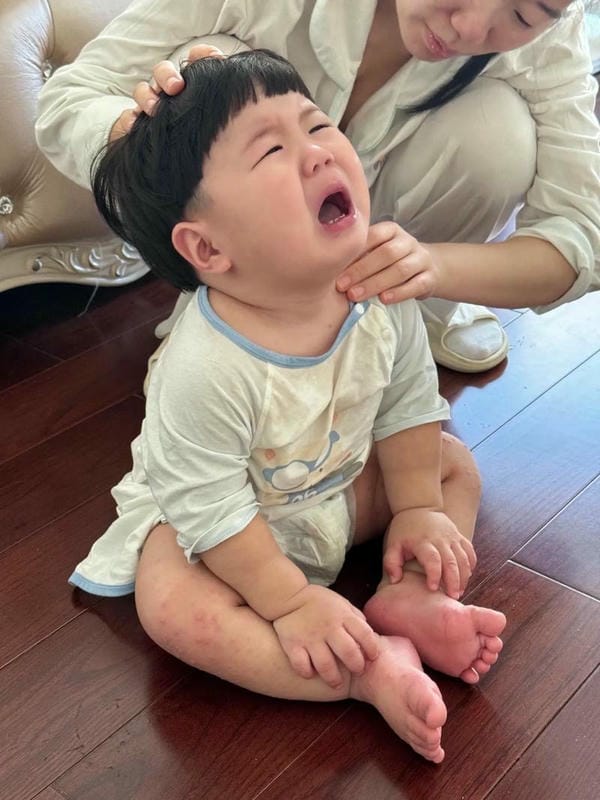 hình ảnh nốt chân tay miệng 14