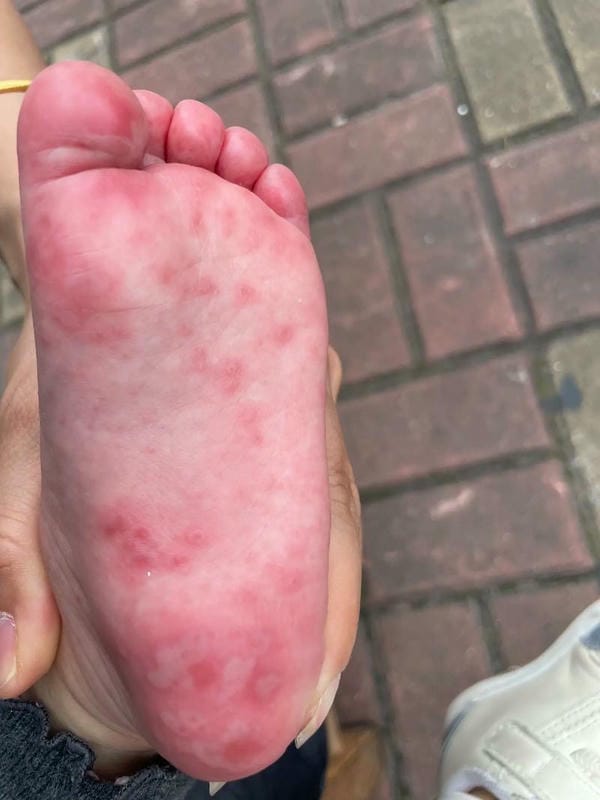 hình ảnh nốt chân tay miệng 19