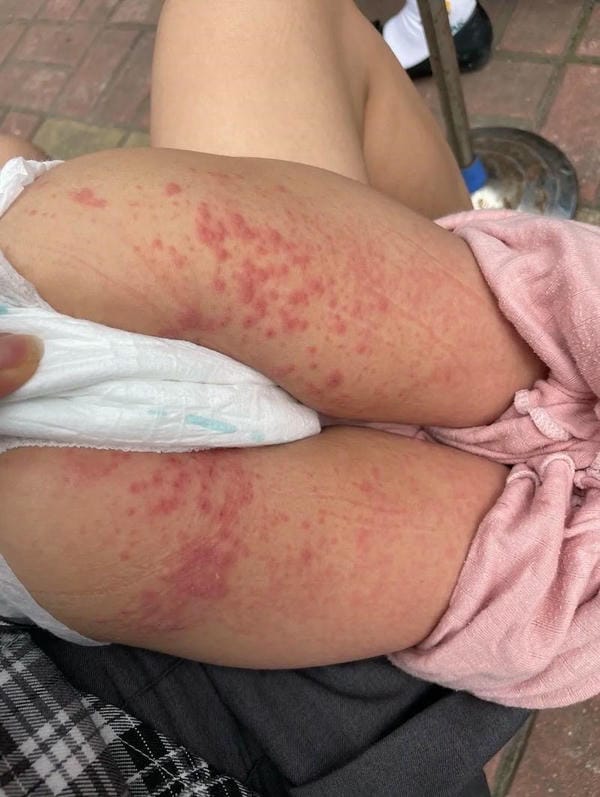 hình ảnh nốt chân tay miệng 20