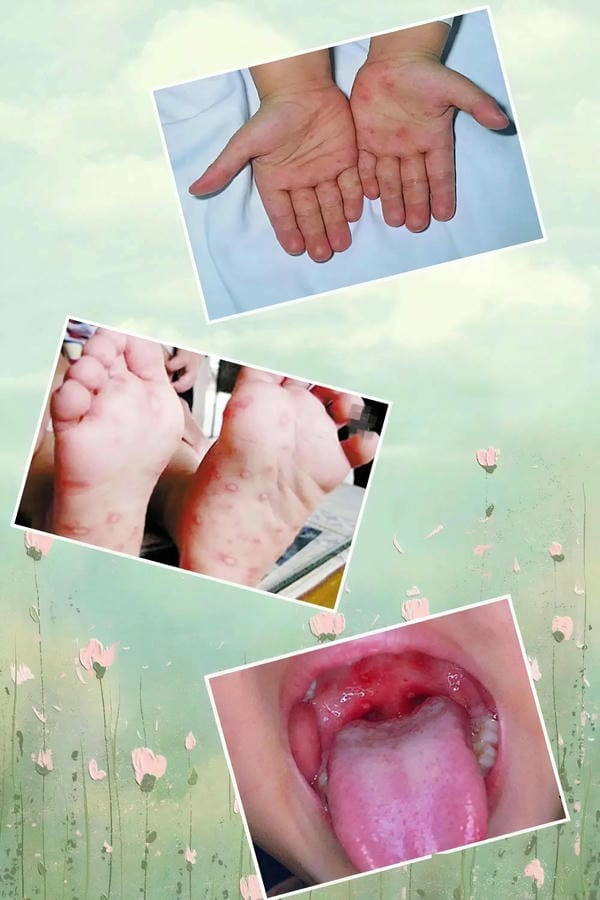 hình ảnh nốt chân tay miệng 28