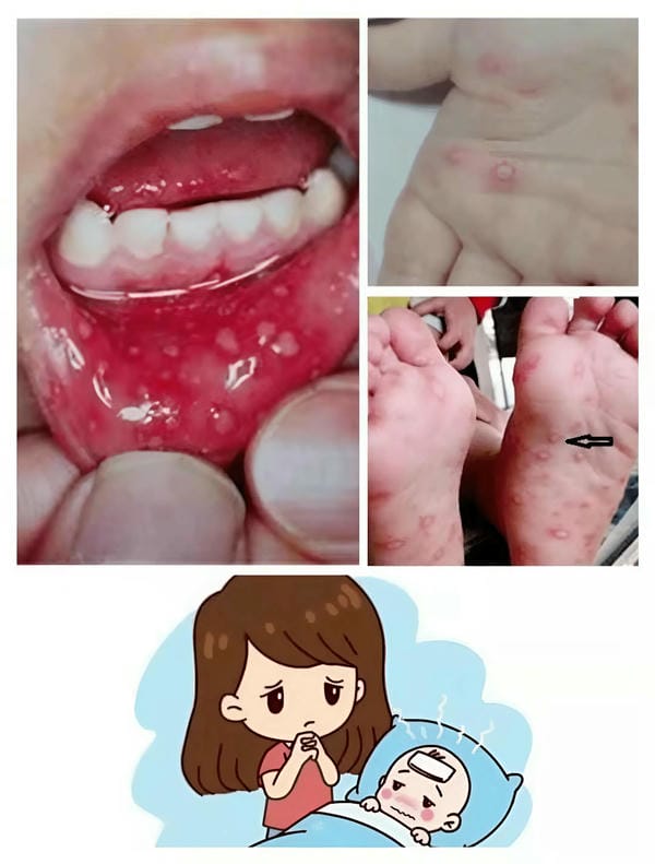 hình ảnh nốt chân tay miệng 29