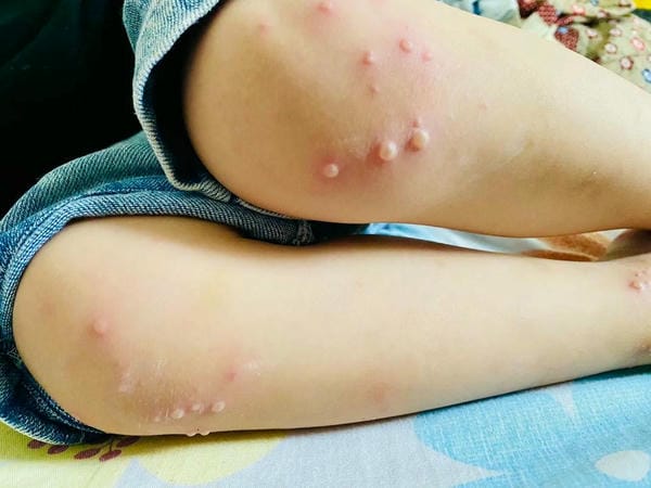 hình ảnh nốt chân tay miệng 3