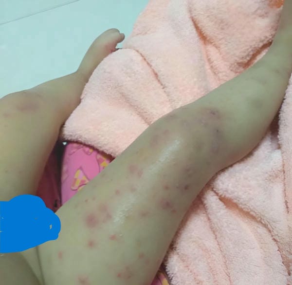hình ảnh nốt chân tay miệng 30