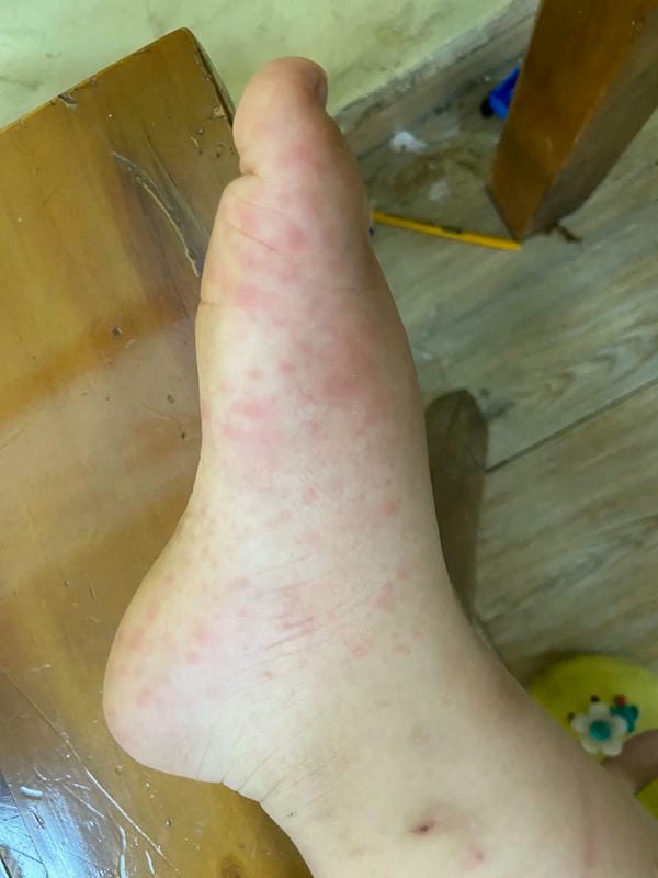 hình ảnh nốt chân tay miệng 6