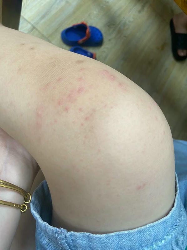 hình ảnh nốt chân tay miệng 7