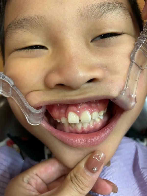hình ảnh răng hô nhẹ 1