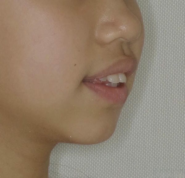 hình ảnh răng hô nhẹ 12