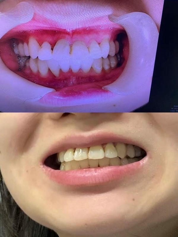 hình ảnh răng hô nhẹ 13
