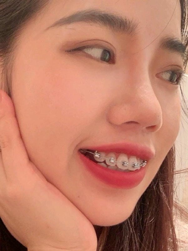 hình ảnh răng hô nhẹ 14