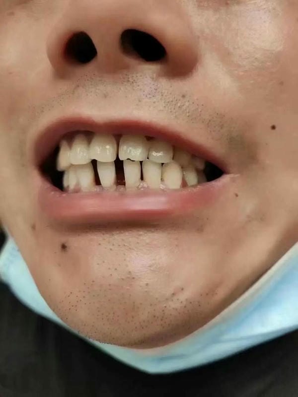 hình ảnh răng hô nhẹ 15
