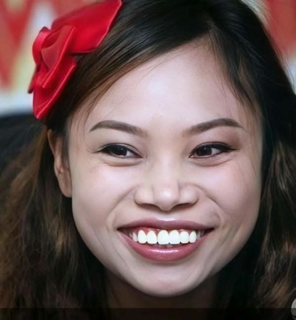 hình ảnh răng hô nhẹ 2