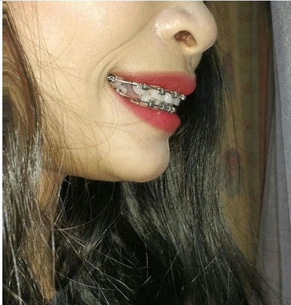 hình ảnh răng hô nhẹ 21