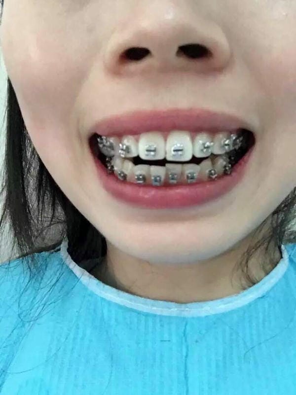 hình ảnh răng hô nhẹ 22