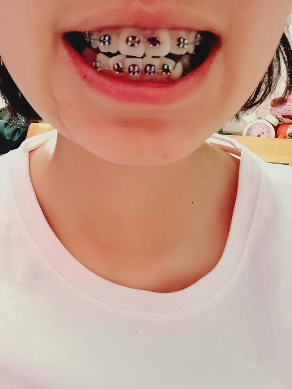 hình ảnh răng hô nhẹ 25