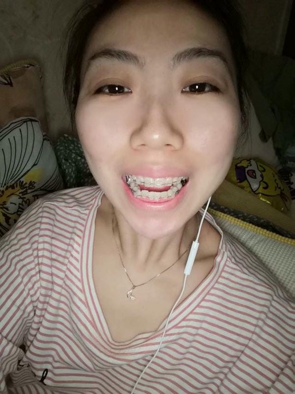 hình ảnh răng hô nhẹ 26