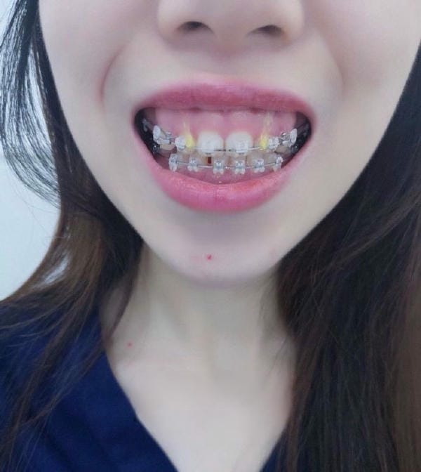 hình ảnh răng hô nhẹ 27