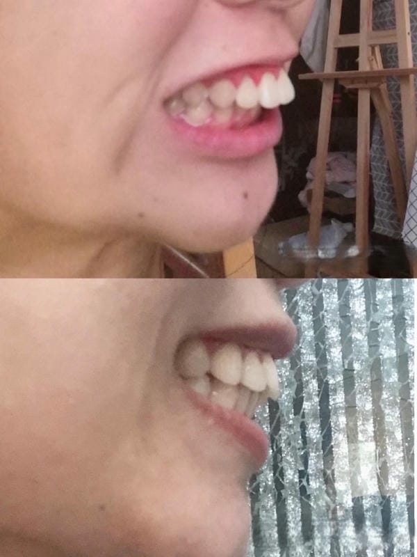 hình ảnh răng hô nhẹ 3