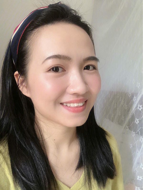 hình ảnh răng hô nhẹ 30