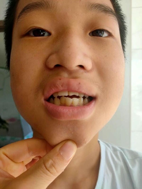 hình ảnh răng hô nhẹ 5