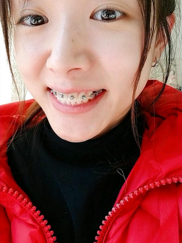 hình ảnh răng hô nhẹ 8