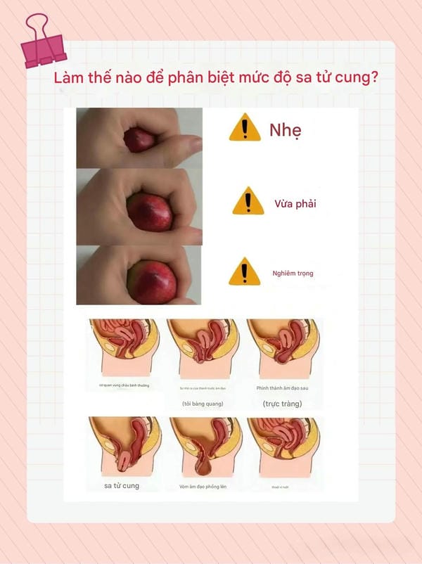 hình ảnh sa tử cung độ 1 1