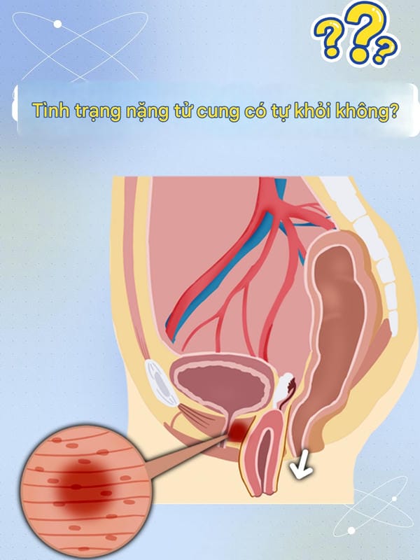 hình ảnh sa tử cung độ 1 10