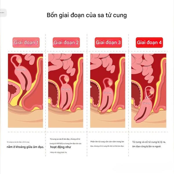 hình ảnh sa tử cung độ 1 12