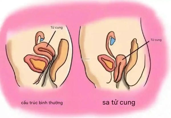 hình ảnh sa tử cung độ 1 18