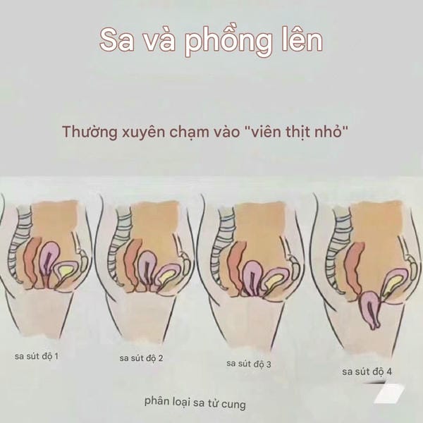 hình ảnh sa tử cung độ 1 2