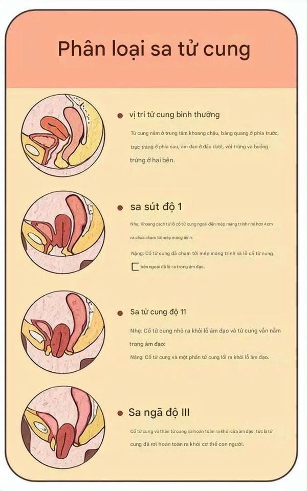 hình ảnh sa tử cung độ 1 3